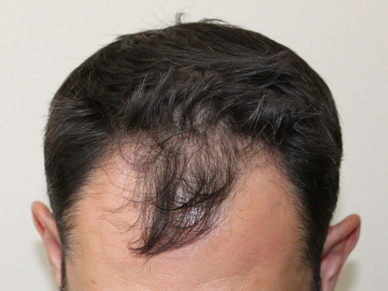Before Hair Transplant 4