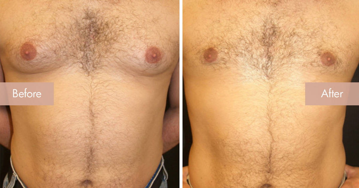 BellaVou-SocialMedia-MaleBreastReduction BellaVou-SocialMedia-MaleBreastReduction