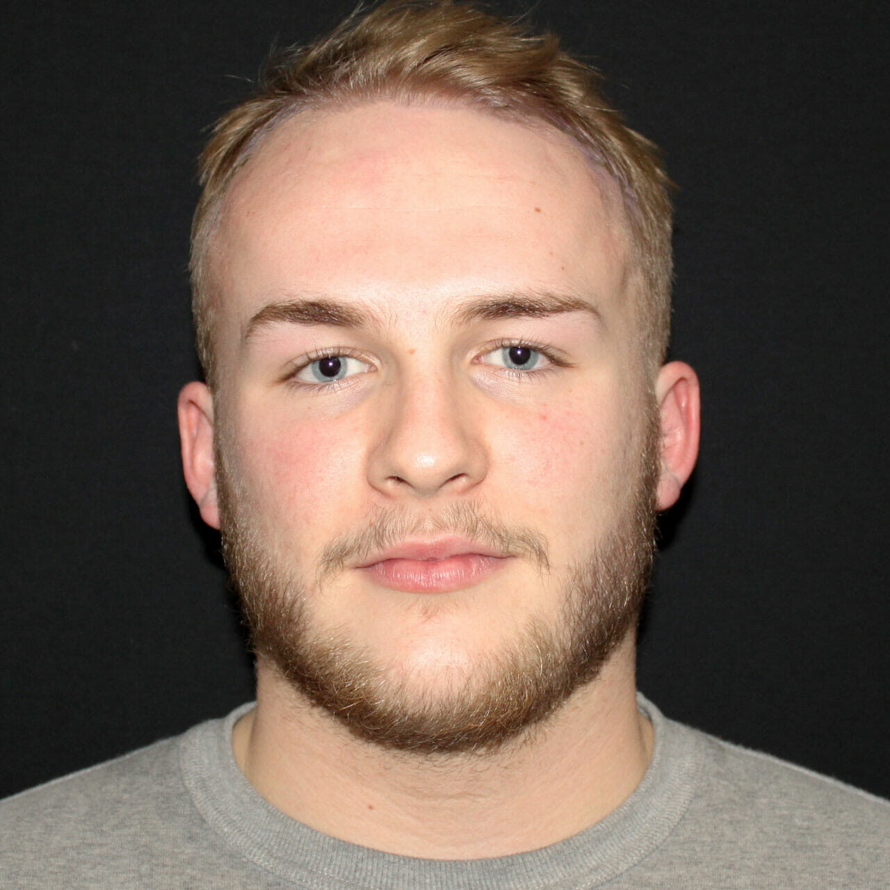 Owen-HairTransplant-Before-18_full Hair Transplant