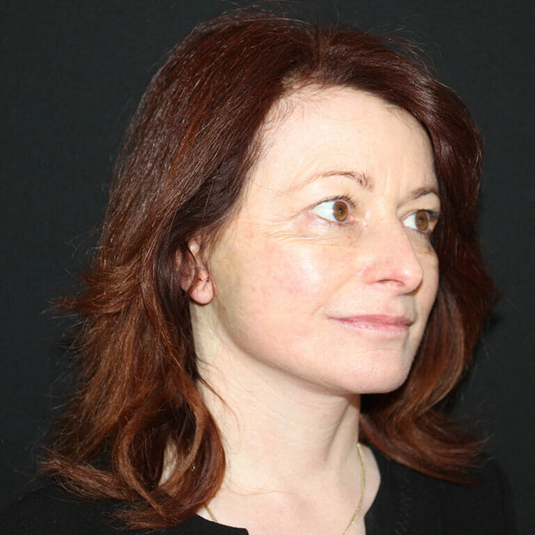 Wendy one day after her Concept Facelift